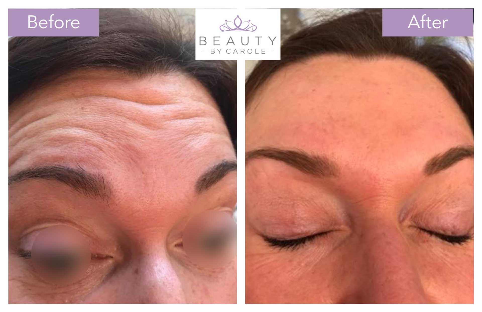 Anti-Wrinkle Injections - Beauty By Carole